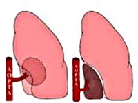Sequestration of pulmon - cauze, simptome, diagnostic și tratament