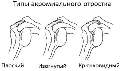 Sindromul conflictelor subacromiale, impingerea sindromului, diagnosticul și tratamentul la Kiev, Ucraina