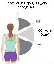 Sindromul conflictelor subacromiale, impingerea sindromului, diagnosticul și tratamentul la Kiev, Ucraina