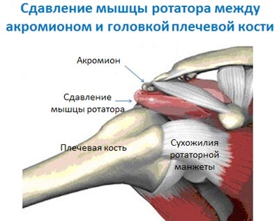 Sindromul conflictelor subacromiale, impingerea sindromului, diagnosticul și tratamentul la Kiev, Ucraina