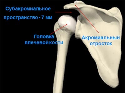 Sindromul conflictelor subacromiale, impingerea sindromului, diagnosticul și tratamentul la Kiev, Ucraina