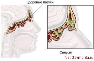 Simptomele sinusite la adulți și copii