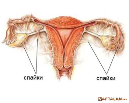 Adeziuni pelviene ale organelor pelvine