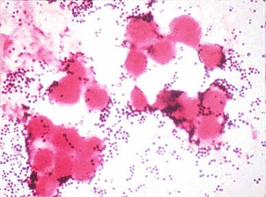 Staphylococcus aureus (S. aureus) - s érzékenység antibiotikumok, MRSA, MSSA,