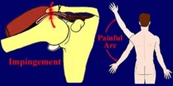 Sindromul de afectare subacromială, afectarea subacromială, sindromul articulației umărului