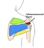 Sindromul de afectare subacromială, afectarea subacromială, sindromul articulației umărului