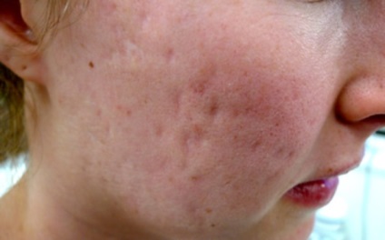 Îndepărtarea cicatricilor după remedii acne de la domiciliu 1
