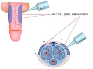 Injecții pentru a crește potența injecțiilor masculine pentru potență în penis