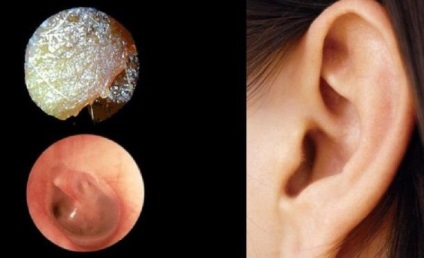 Earwax vă va spune totul despre sănătatea dumneavoastră!