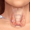 Simptomele tiroidiene și nodul de tratament, pro shchitovidku