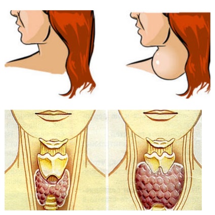 Simptomele tiroidiene și nodul de tratament, pro shchitovidku