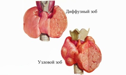Glanda gingivală a simptomelor glandei tiroide și tratamentul bolii