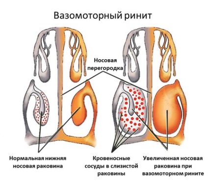 Tratamentul rinitei vasomotorii, simptome, cauze