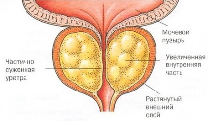 Tipuri de cauze de prostatită și caracteristici ale dezvoltării fiecărei specii