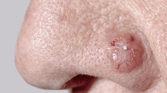 Tot ce trebuie să știți despre pielea bazală - de la simptome până la tratament, se acumulează pe piele