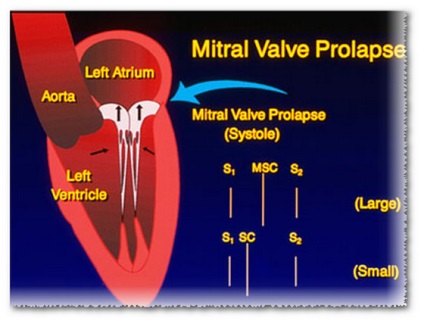 Cel de-al doilea grad de prolaps a valvei mitrale