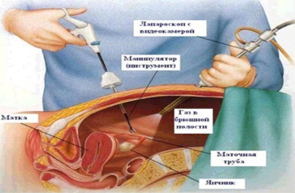 Umflare după laparoscopie, cauze de abdomen umflat