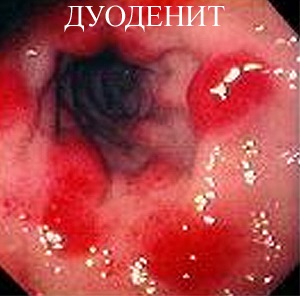 Simptomele duodenitei cronice, semne, cauze, cum să tratezi duodenita - tratament în clinica 