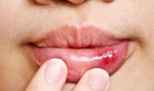 Răni în gură și răni provoacă și tratamentul la domiciliu