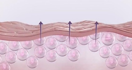 Juvederm (juvederm) revizuirea materialelor de umplutură, recenzii, fotografii, prețul medicamentelor