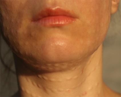 Juvederm (juvederm) revizuirea materialelor de umplutură, recenzii, fotografii, prețul medicamentelor