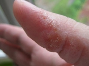 Eczema pielii, îngrijirea pielii cu probleme