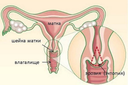 Afecțiuni ginecologice feminine, tipurile lor pe o fotografie și tratamentul național al fungilor și hormonali