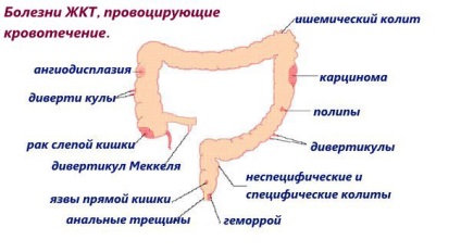 Sângerare gastrointestinală