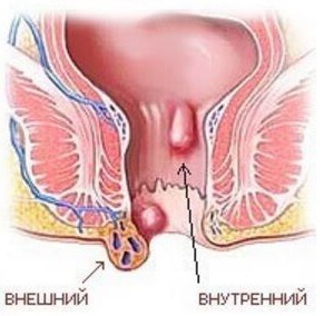 Sângerare gastrointestinală