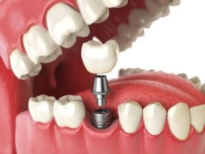 Dental implants mis (Israel), preturi, poze