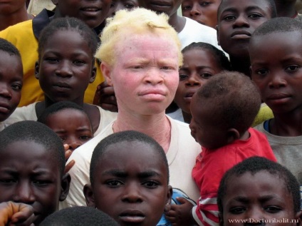 Albinism Doctor Aybolit - un site medical pentru medici și asistente medicale