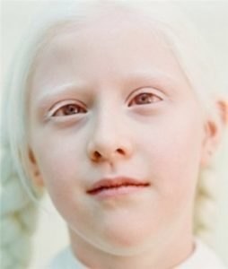 Cauzele albinismului, simptomele, tratamentul, prevenirea