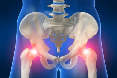 hip arthritis