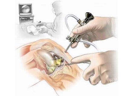 Térd arthroscopy - vizsgálat és kezelés „egy üveg”