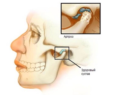 Artroza vnchs - simptome, diagnostic, tratament