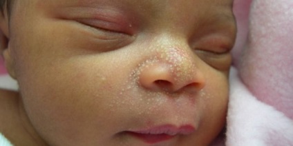 Coșuri de culoare albă pe fața unui copil, într-o fotografie adultă, tratament