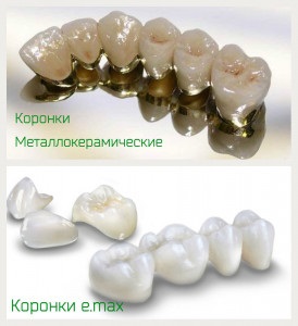 Kerámia (préselt kerámia Emax) kerámia