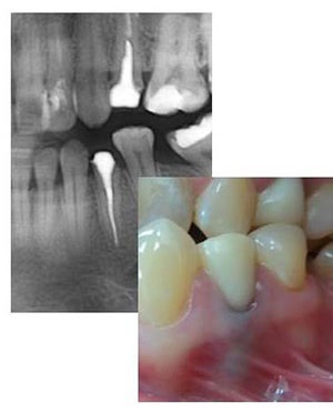 Metal-free crowns e-max - un sistem inovator de ceramica solida in stomatologie dent organic,