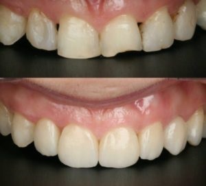 Metal-free crowns e-max - un sistem inovator de ceramica solida in stomatologie dent organic,