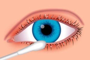 Blepharitis - tünetek és kezelés