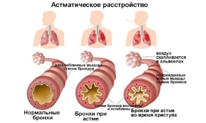 Astmul bronșic și psihosomia astmului și cauzele psihologice la adulți