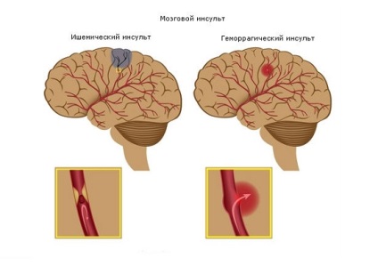 Ce să se apere după un accident vascular cerebral, oamenii de știință au numit factorul de risc