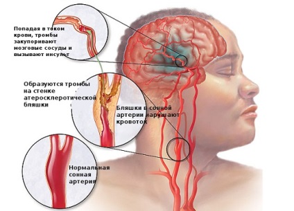 Чого варто остерігатися після інсульту вчені назвали фактор ризику