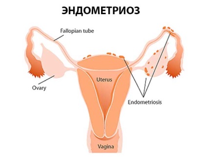 Ce este endometrioza formei, cauzează tratamentul