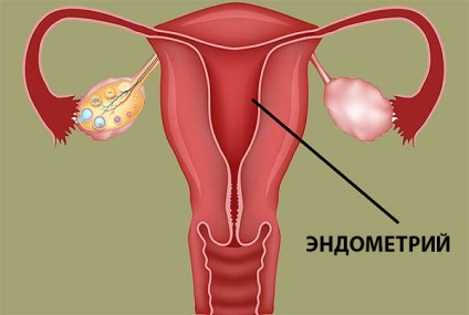 Ce este endometrioza formei, cauzează tratamentul