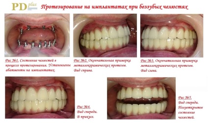 Implantologie dentară - perspectiva