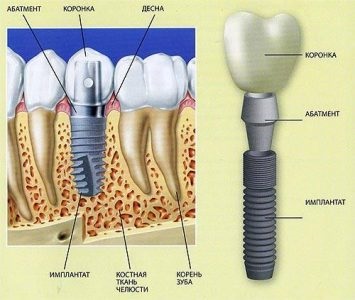 Implantologie dentară - perspectiva