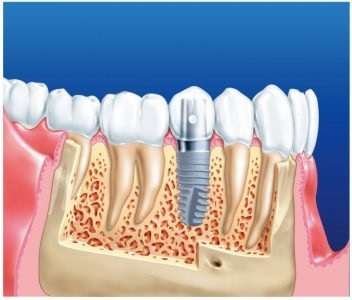 Implantologie dentară - perspectiva