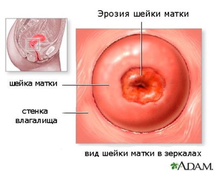 Diathermocoagularea și criodestrucția consecințelor eroziunii cervicale ale tratamentului