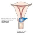 Diathermocoagularea și criodestrucția consecințelor eroziunii cervicale ale tratamentului